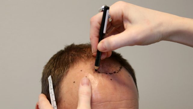 Kostnadsbilden för hårtransplantation hos 85 Kliniken i korthet